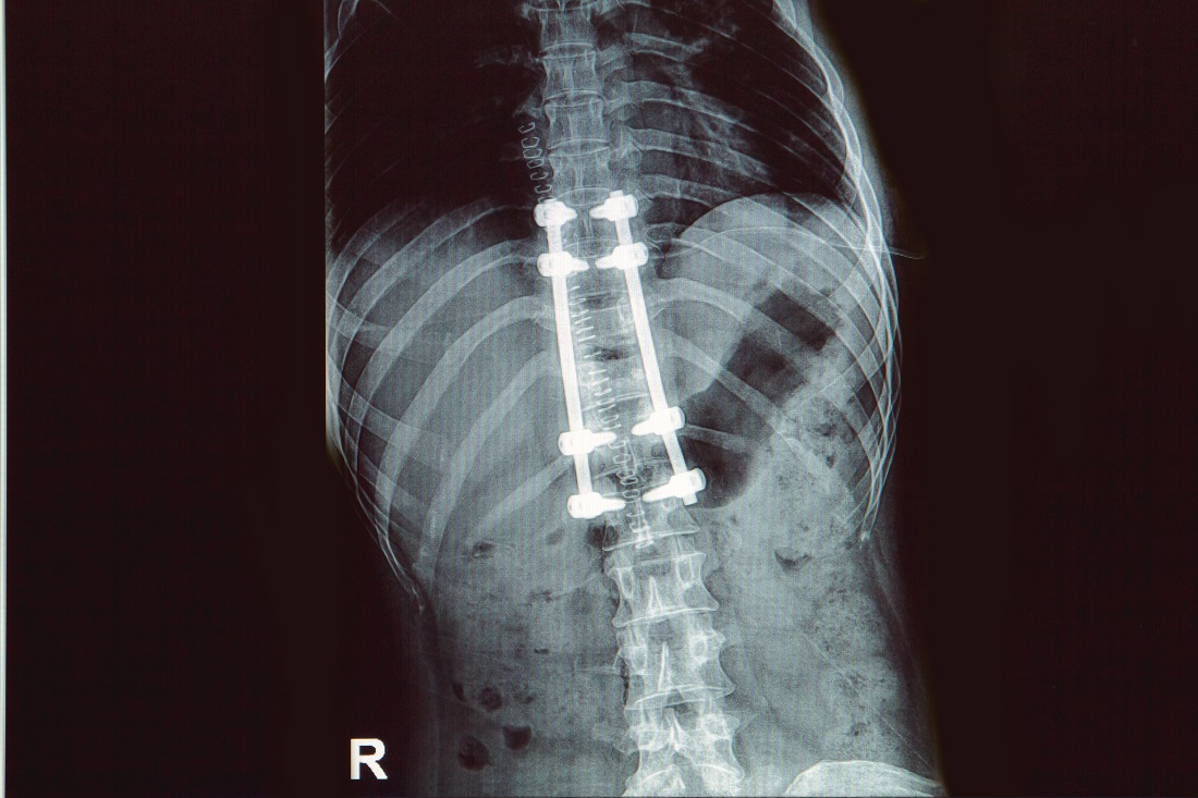  spinal implant man paralyzed again new most 